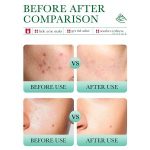 Bioaqua Salicylic Acid Acne Marks Removal Cleanser 100g - Image 3